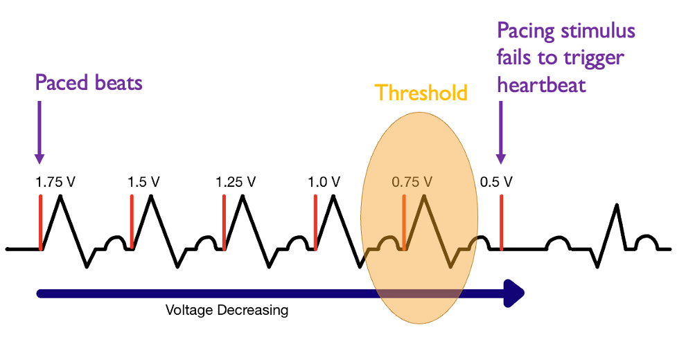 Dr. Wes: Could a Bra Interact With a Pacemaker or Defibrillator?