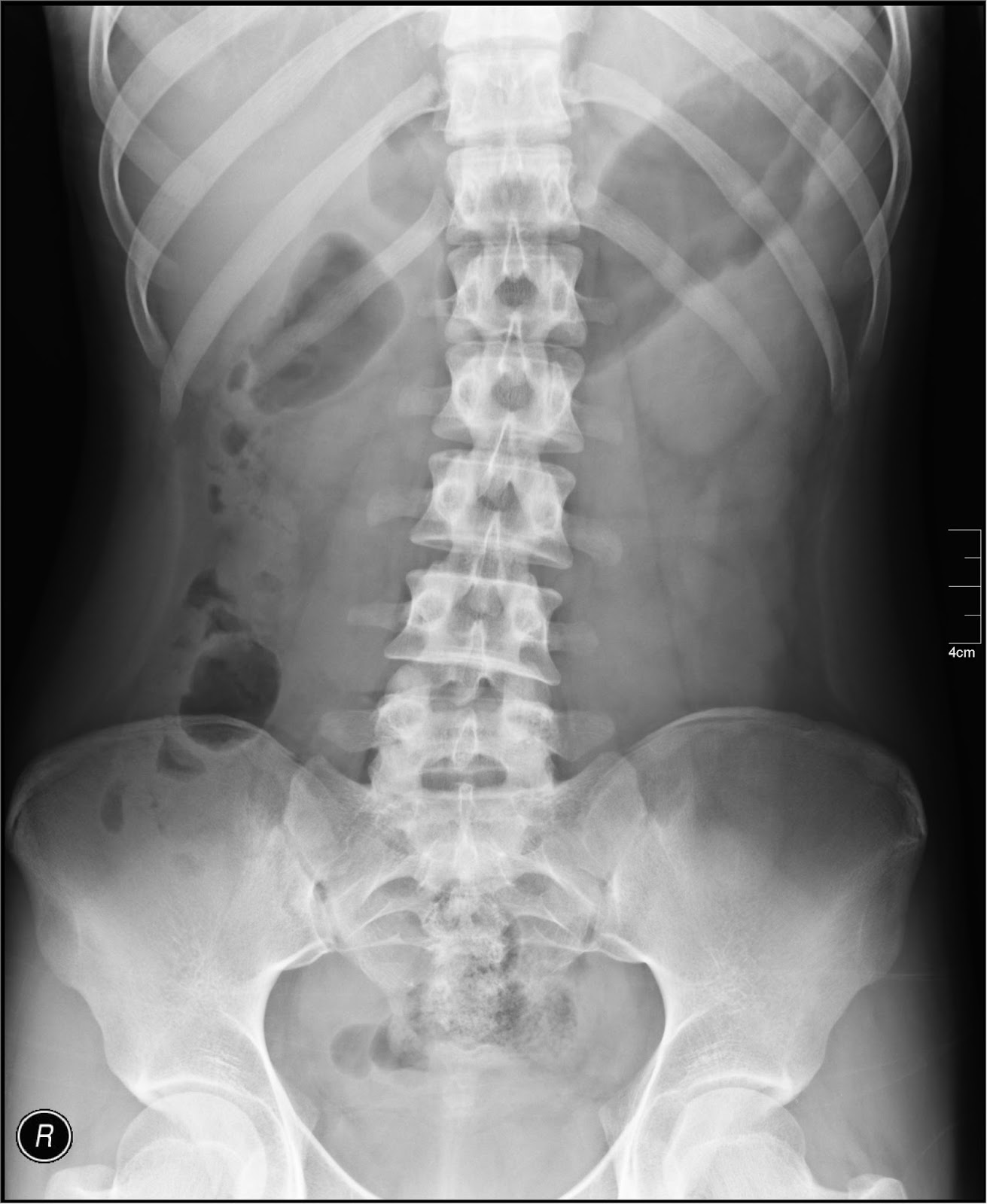 Abdominal X-Rays: What's the Point? - EMOttawa