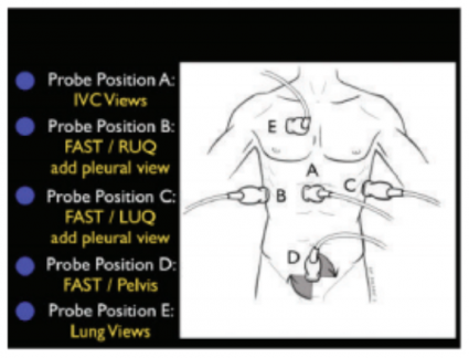 Focus on POCUS: Heartbreaker. Cardiac Echo in the ED. - EMOttawa Blog