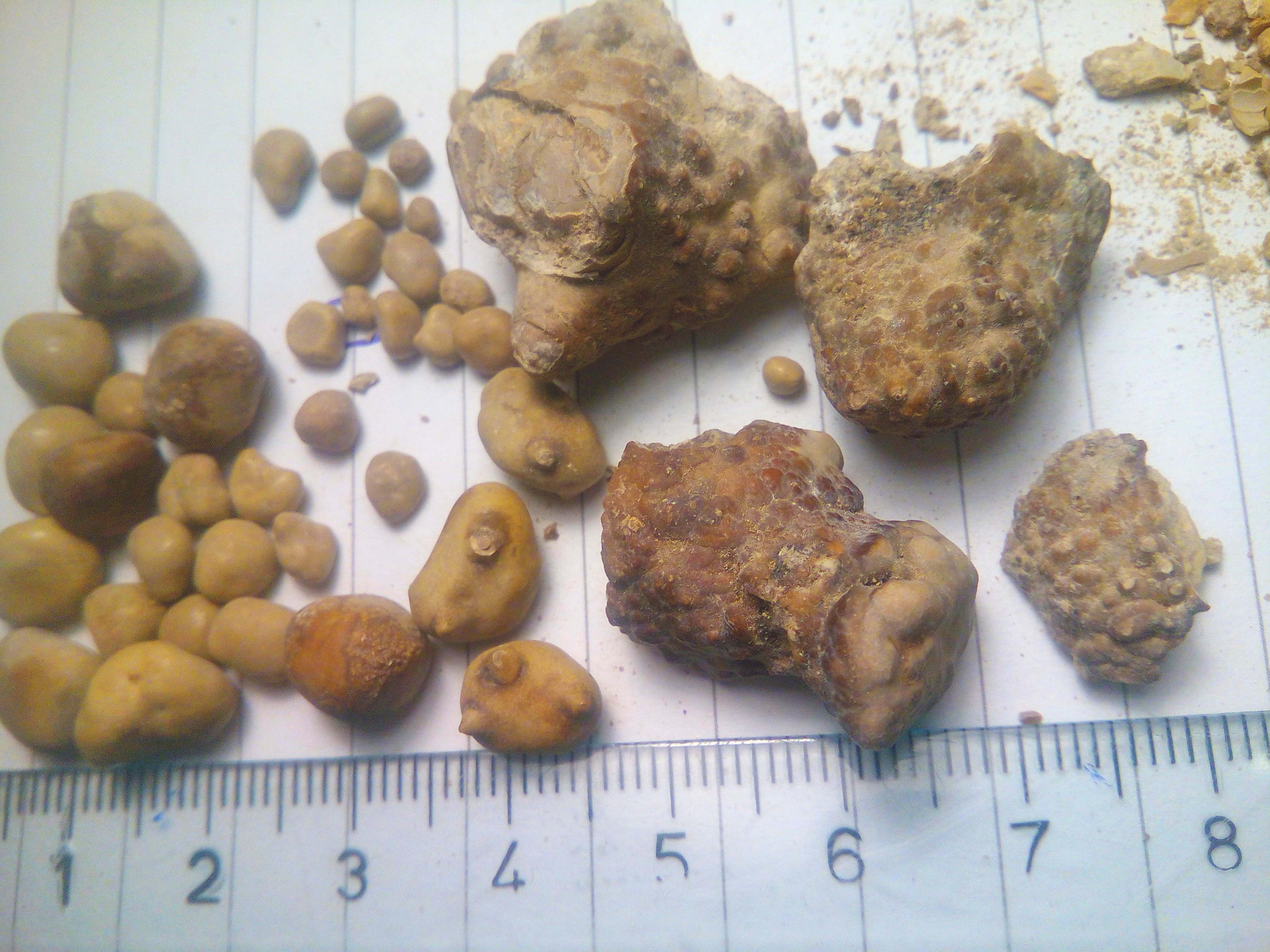 Collection of actual kidney stones of varying sizes laid out with a ruler for scale