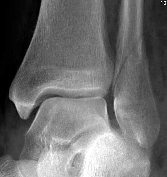 Three week versus six week immobilisation for stable Weber B type ankle fractures: randomised, multicentre, non-inferiority clinical trial