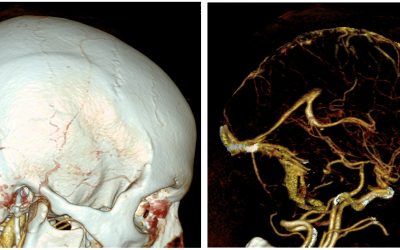 CNS Compartment Syndrome: Cerebral Venous Thrombosis