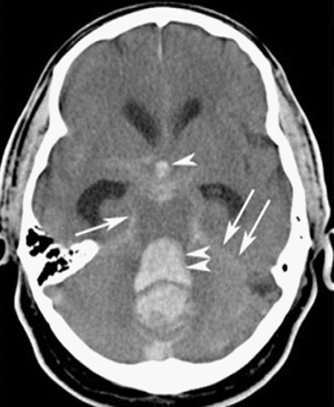 Ultra-early tranexamic acid after subarachnoid haemorrhage (ULTRA): a randomised controlled trial