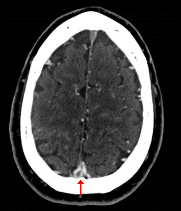 Cerebral venous thrombosis