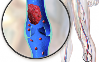 A simplified decision rule to rule out deep vein thrombosis using clinical assessment and D-dimer