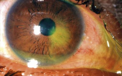 Topical pain control for corneal abrasions: A systematic review and meta-analysis