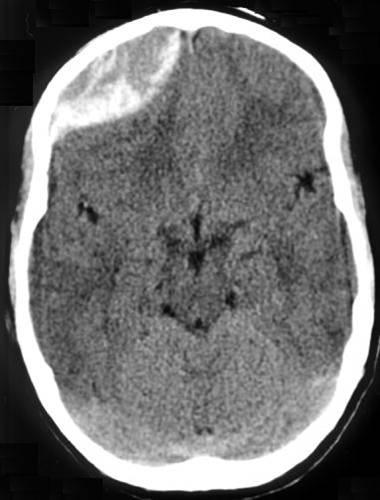 Intracranial hemorrhage after head injury among older patients on anticoagulation seen in the emergency department: a population-based cohort study