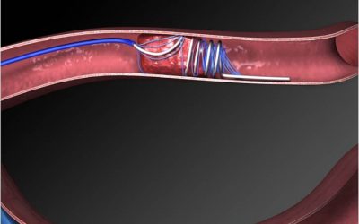 Thrombectomy for anterior circulation stroke beyond 6 h from time last known well (AURORA): a systematic review and individual patient data meta-analysis