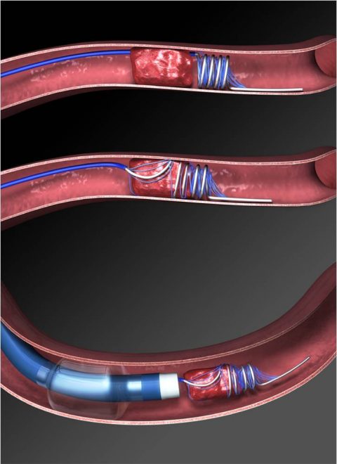 Thrombectomy For Anterior Circulation Stroke Beyond 6 H From Time Last 