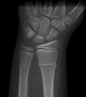 Immobilisation of torus fractures of the wrist in children (FORCE): a randomised controlled equivalence trial in the UK.