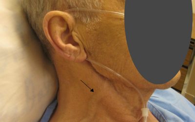 Accuracy of Ultrasound Jugular Venous Pressure Height in Predicting Central Venous Congestion