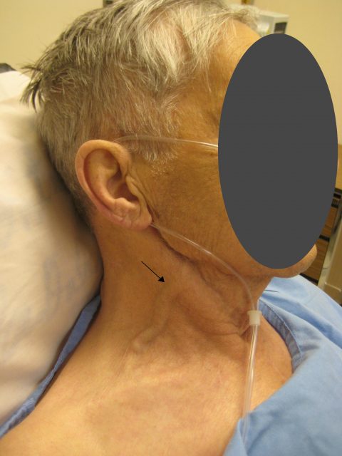 Accuracy of Ultrasound Jugular Venous Pressure Height in Predicting ...