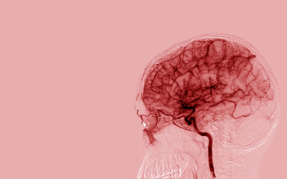 Spontaneous Intracerebral Hemorrhage - Stroke Not Copyright2 980x613 