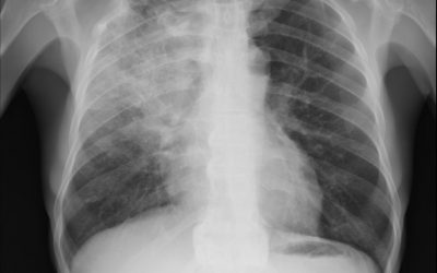 Hydrocortisone in Severe Community-Acquired Pneumonia