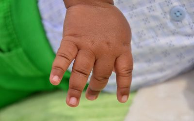 Multifaceted quality improvement initiatives improve rate of pediatric hand injury reduction