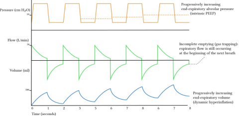 Lung Protective Ventilation - EMOttawa Blog