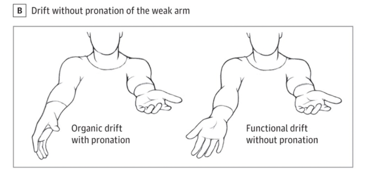 Functional Neurologic Disorders EMOttawa Blog