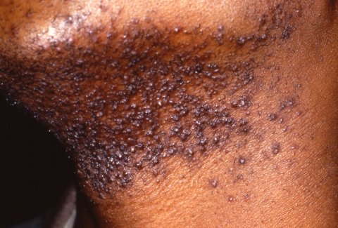 Image of chin and neck showing dark coloured skin with numerous small dark brown and purple pigmented papules overlying the area on a lighter base. These findings are reflective of pseudofolliculitis barbae.