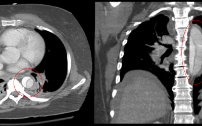 Diagnostic Accuracy of D-Dimer for Acute Aortic Syndromes: Systematic Review and Meta-Analysis