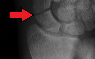 Can we avoid casting for suspected scaphoid fractures? A multicenter randomized controlled trial