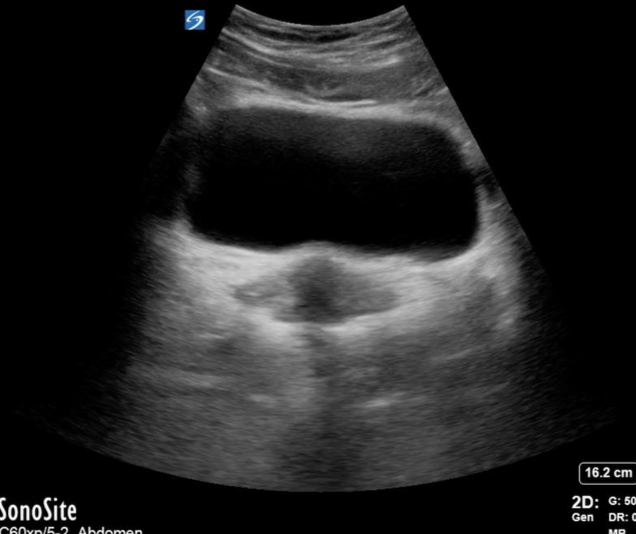 ovarian pocus