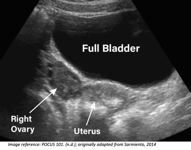ovarian pocus