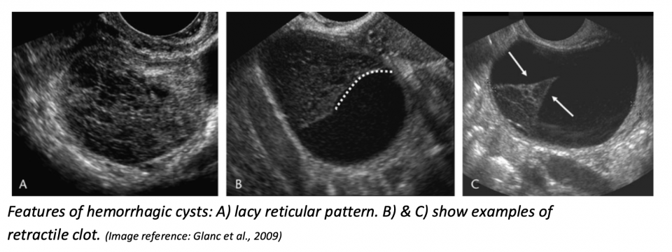 ovarian pocus