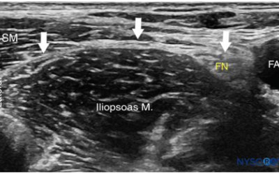 Hip Fractures and the Battle of the Blocks: SIFI vs IIFI