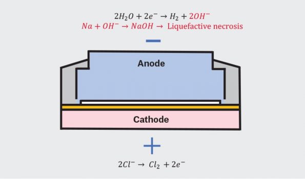 button battery ingestion