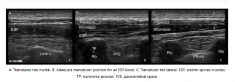 Central Rib Block Rib Fractures and Regional Anesthesia: Rib Blocks - EMOttawa Blog