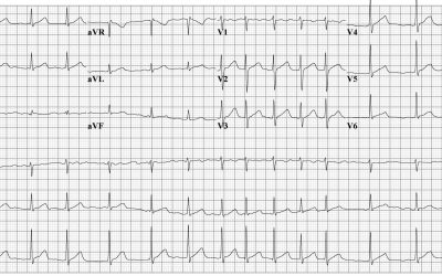 Vernakalant versus procainamide for rapid cardioversion of patients with acute atrial fibrillation (RAFF4): randomised clinical trial