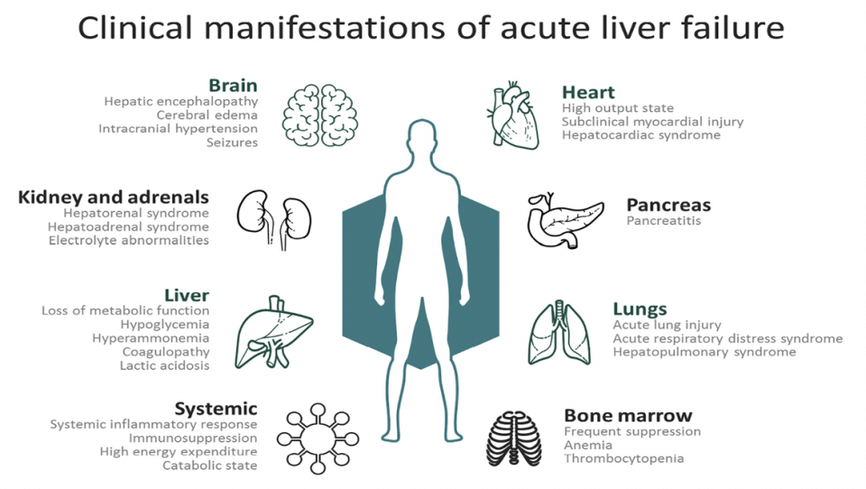 liver failure