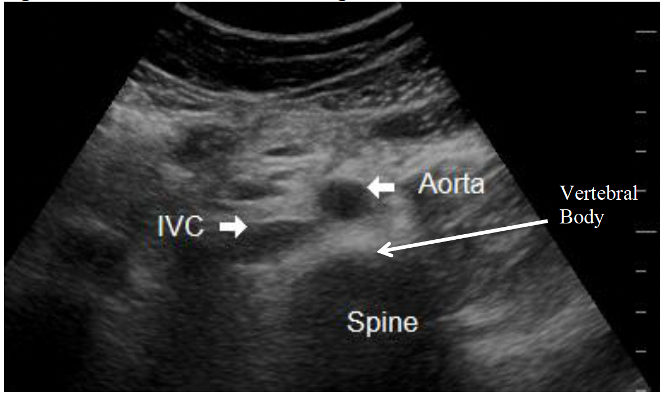 aorta
