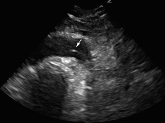 aorta