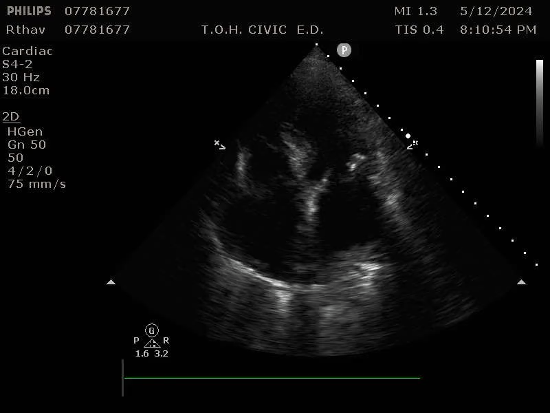valvular pocus