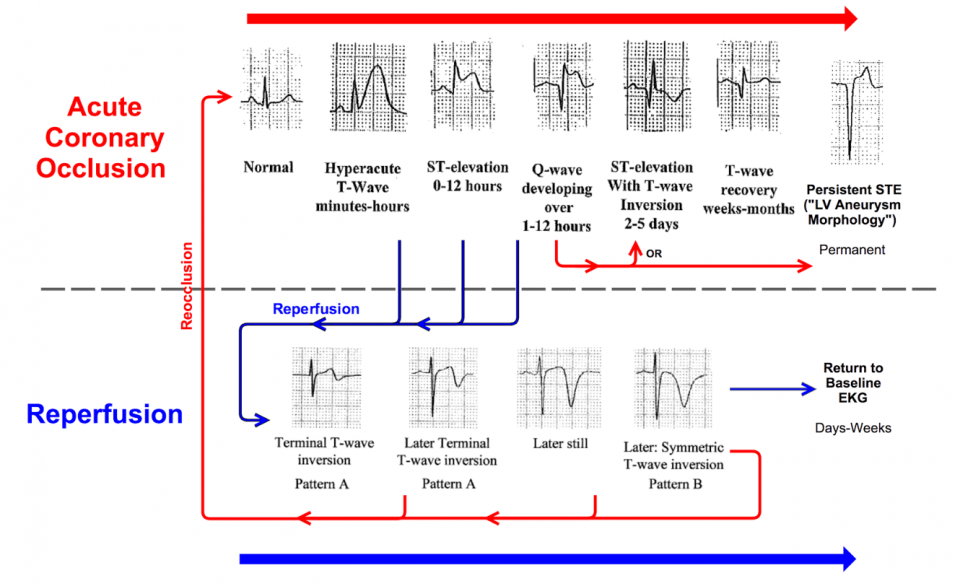 STEMI