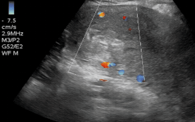 Diagnosing Retained Products of Conception with PoCUS